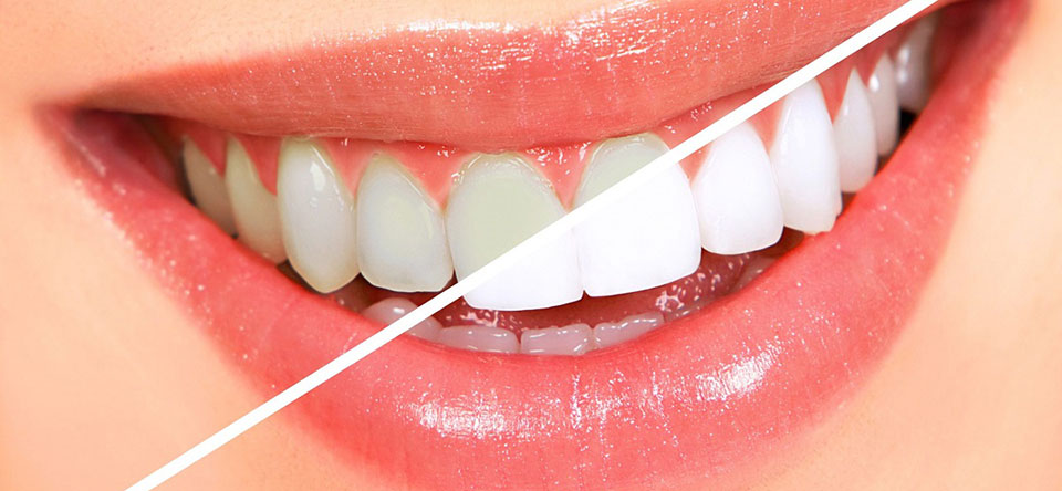 Whitening Procedures